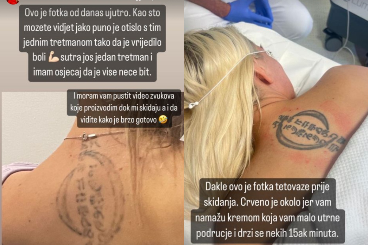 Ella Dvornik uklonila tetovažu